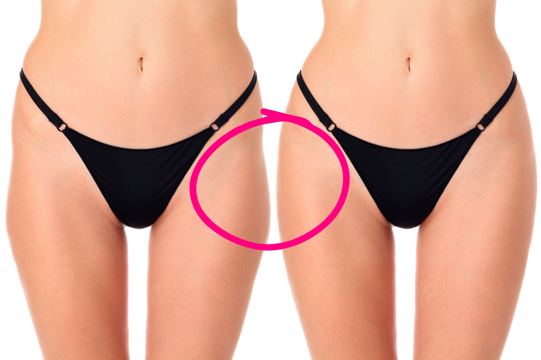 A picture showing a woman's figure, one with hip dips and one without